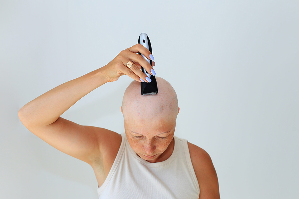 consequences of chemotherapy. Shaving off the last hair on the head with a razor. Head and razor. Total alopecia in a woman. Bald head. Hair in arms and bald head